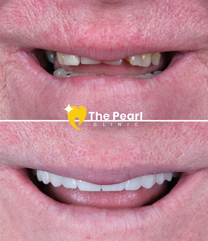 Before Dental Implant 2