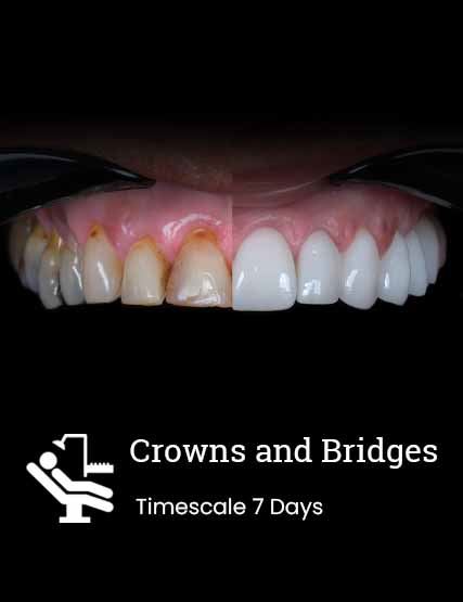 Turkish Crowns and Bridges