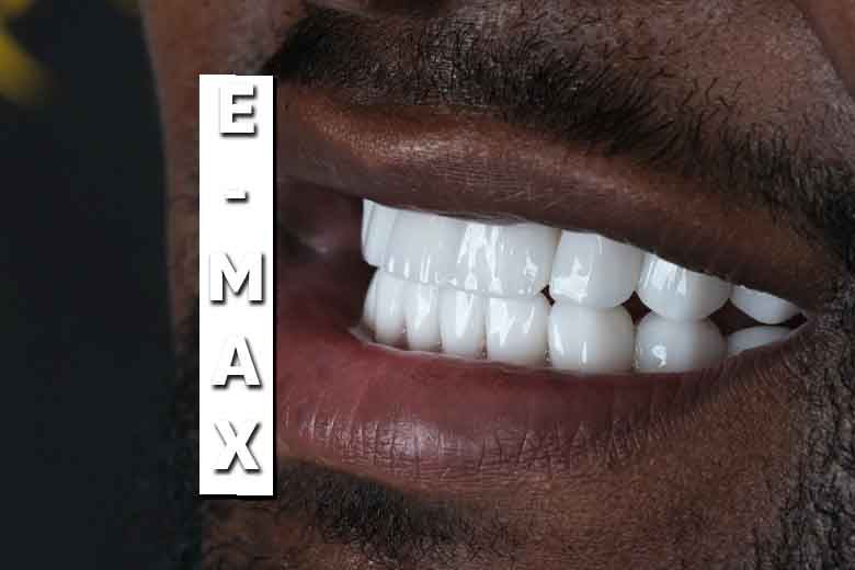 Get a Natural, Lasting Smile with E-Max Veneers in Antalya
