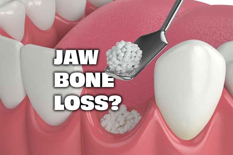 Take the First Step to Implants — Bone Grafting Made Easy!