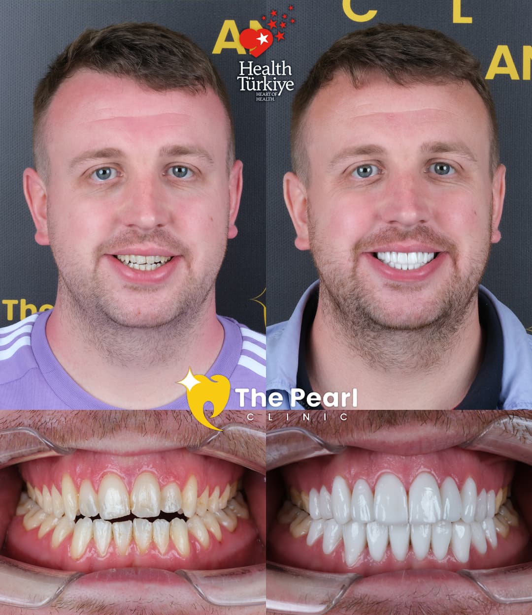 Ламинированный шпон – BL2 – Натуральный стиль