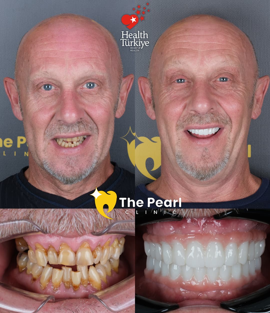 All-on-4 – BL3 – Зрелый стиль