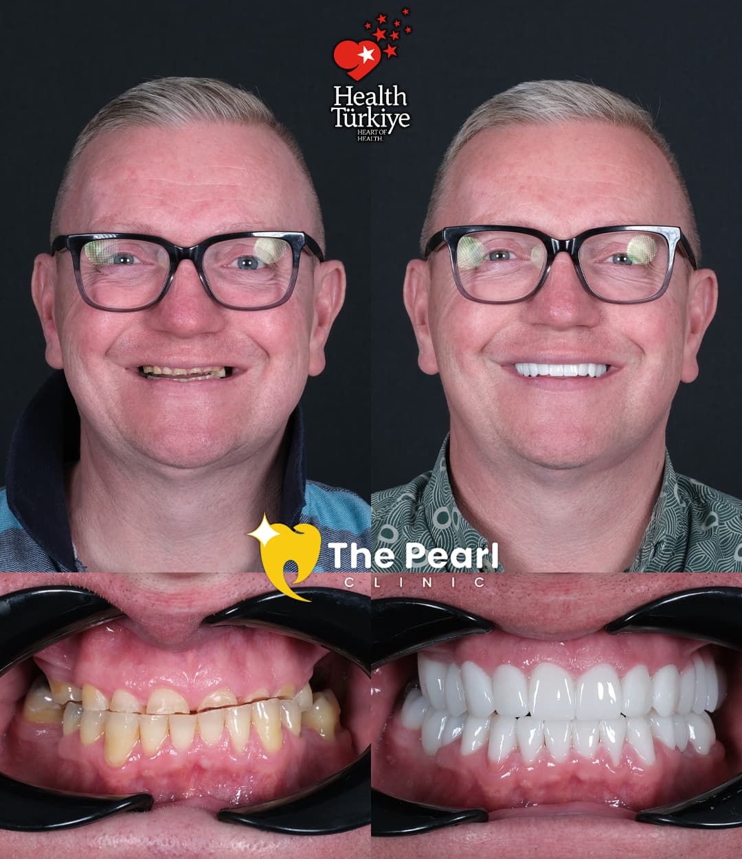 Циркониевые коронки