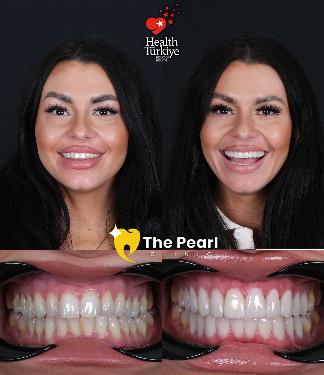 Ламинированный шпон – BL2 – Натуральный стиль