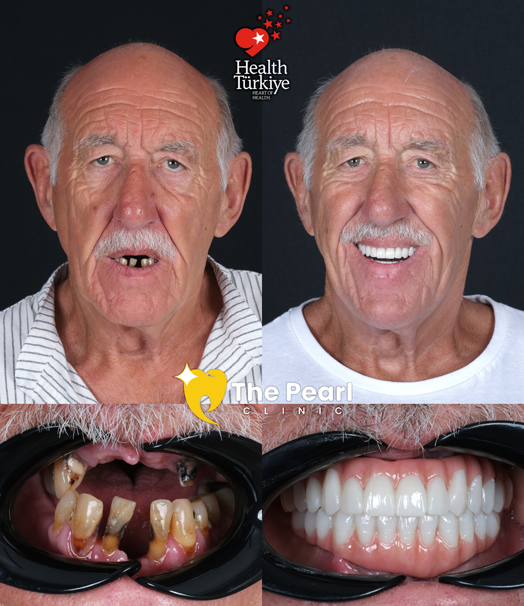 16 E-max Veneers – BL2 Shade