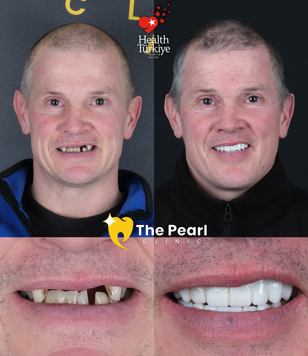 Временная корона