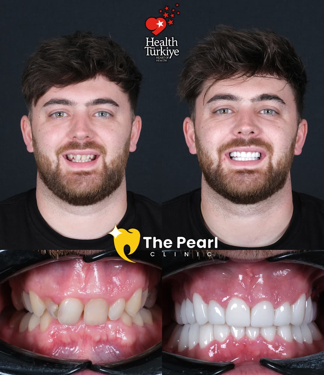 Циркониевые коронки