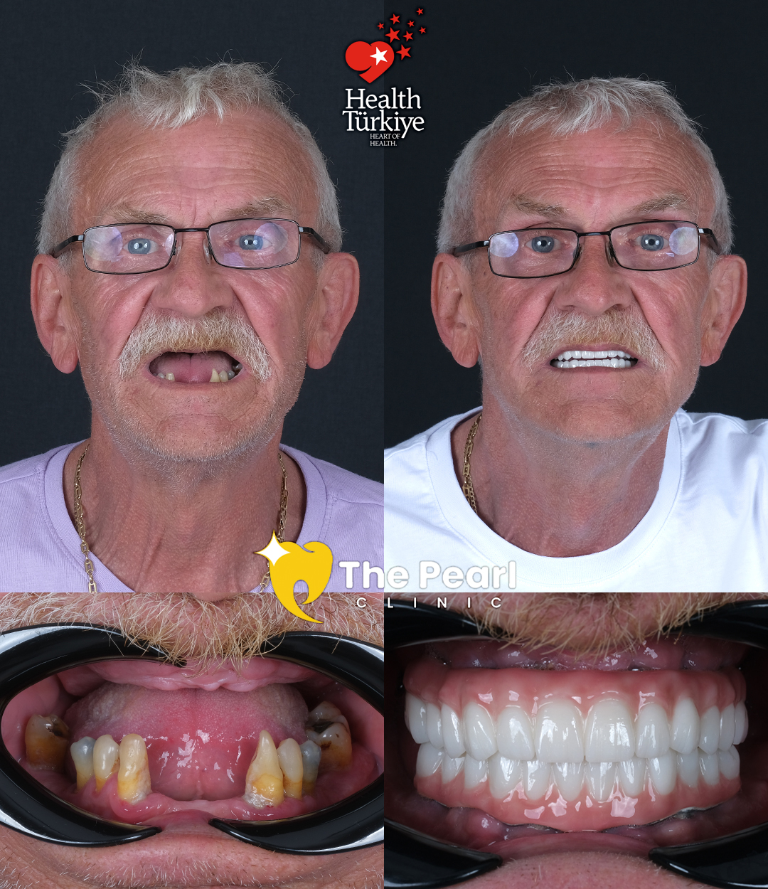 Hollywood Smile Transformation