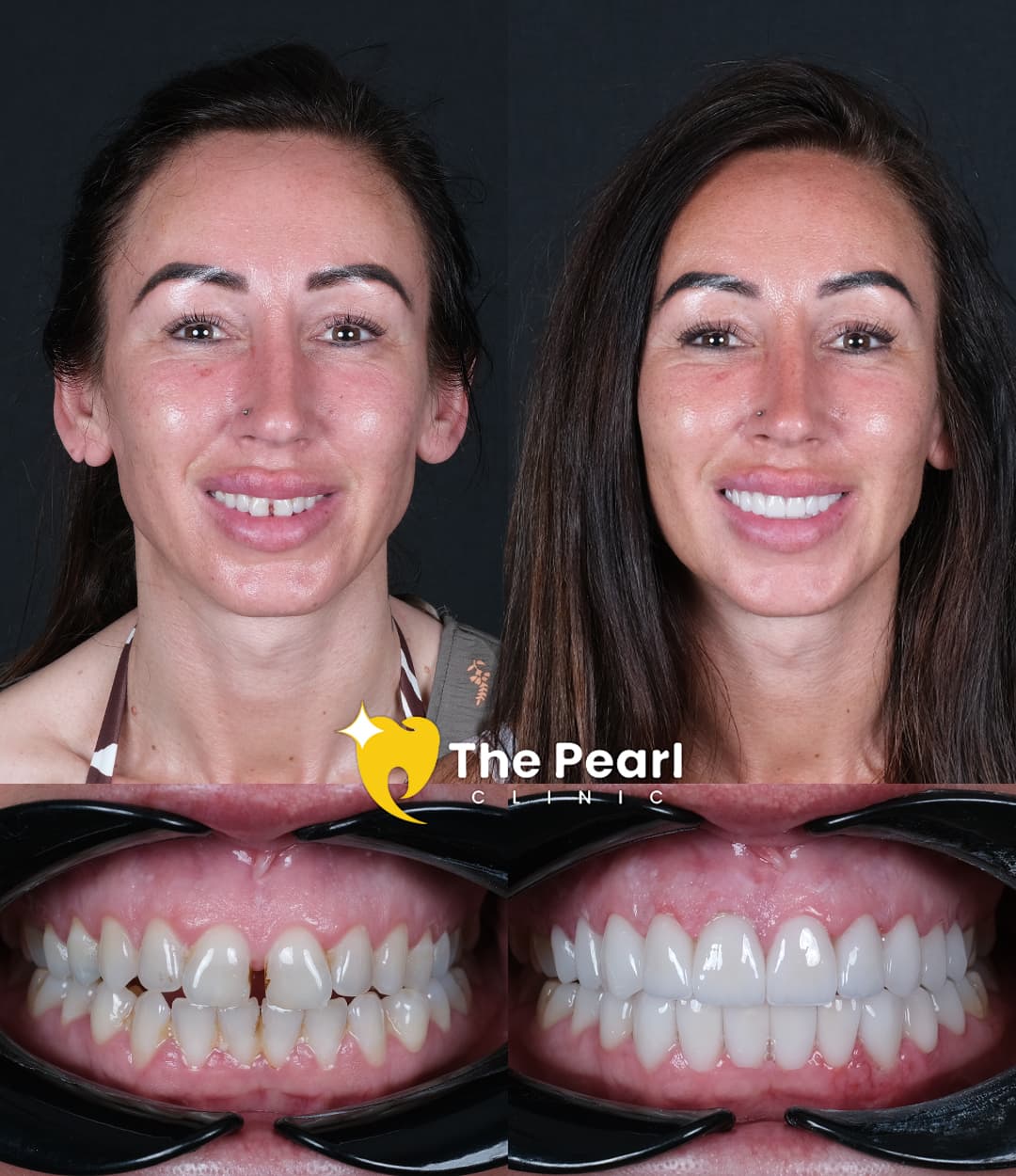 Ламинированный шпон – BL2 – Натуральный стиль