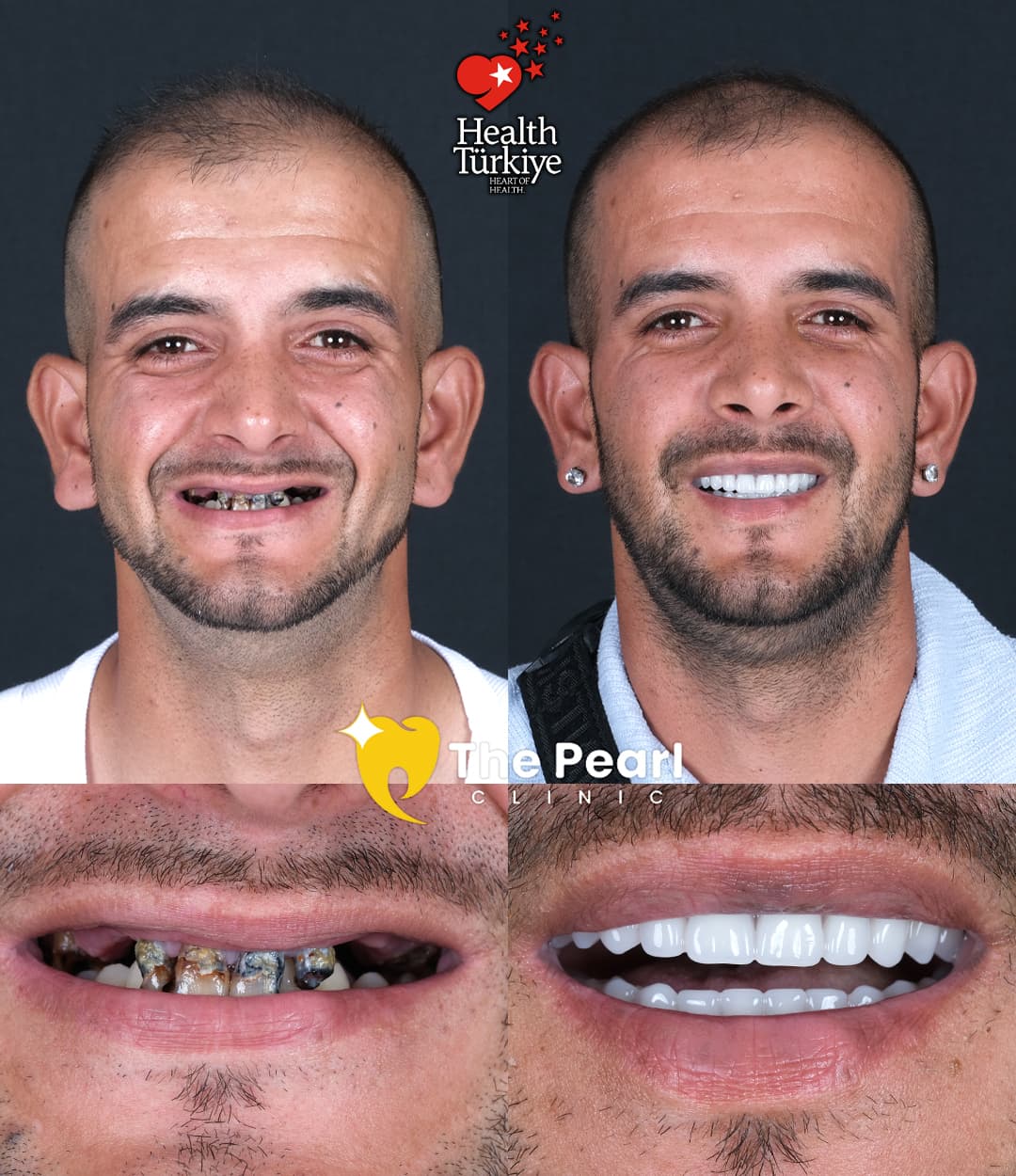 Временная корона