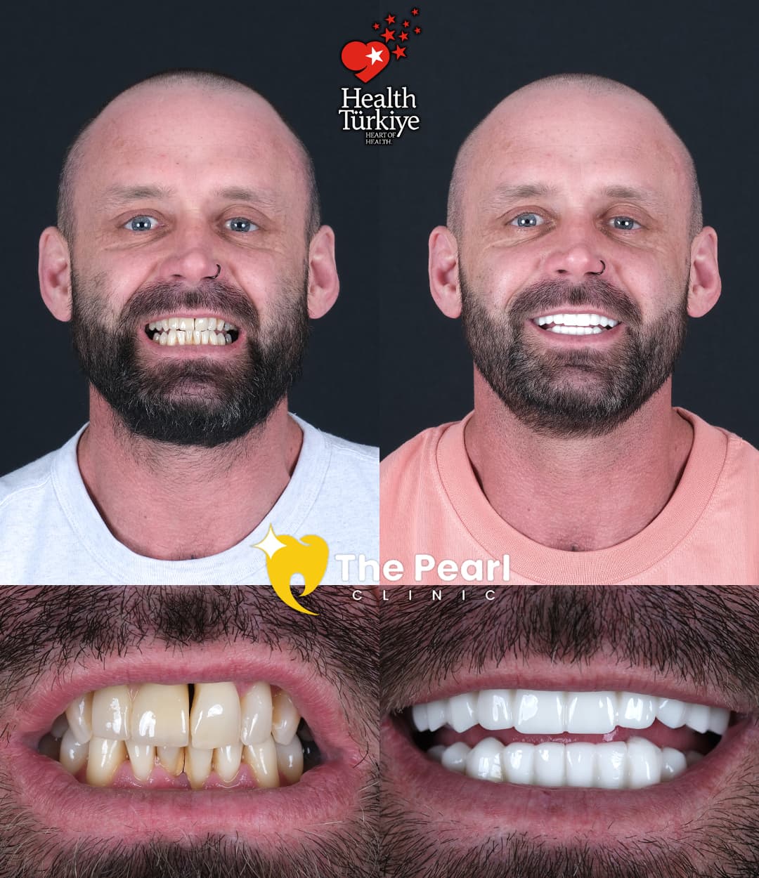 Временная корона