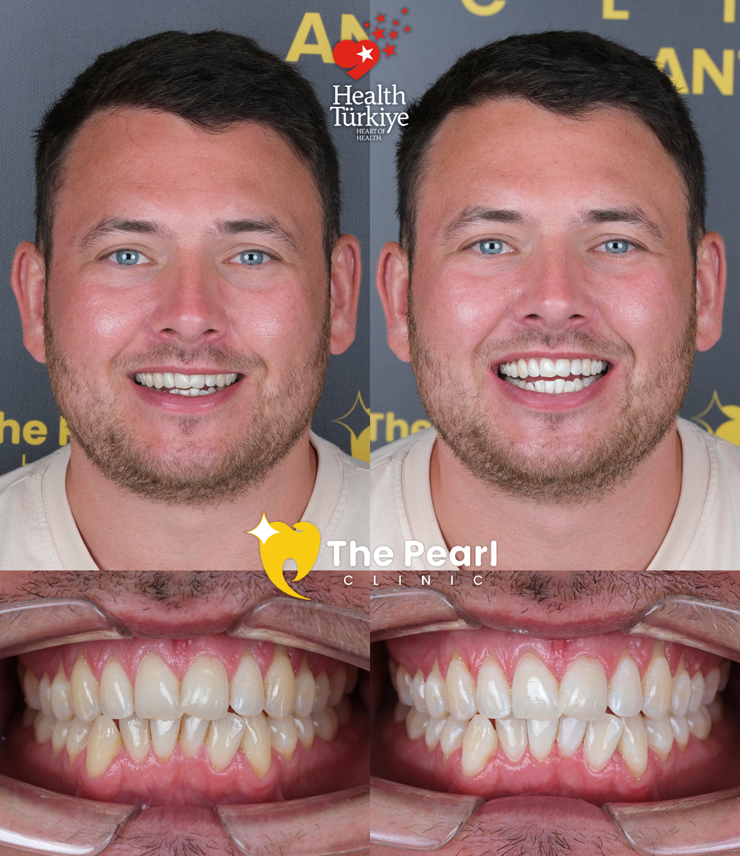 Отбеливание