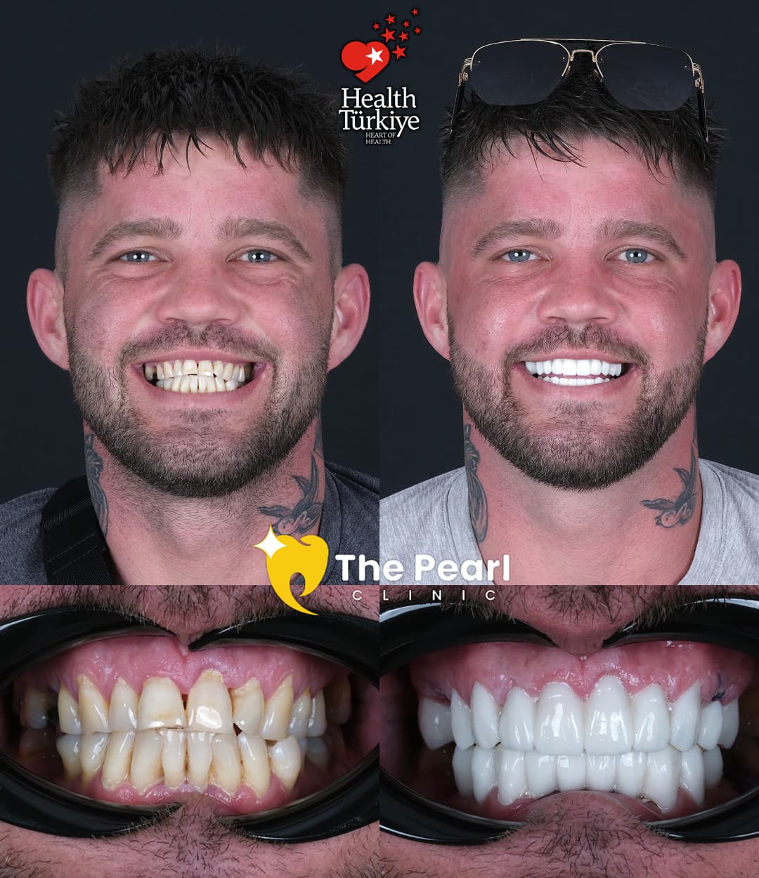 Временная корона