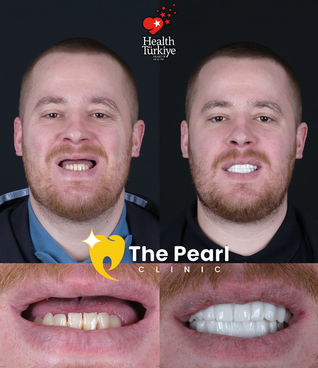 Временная корона