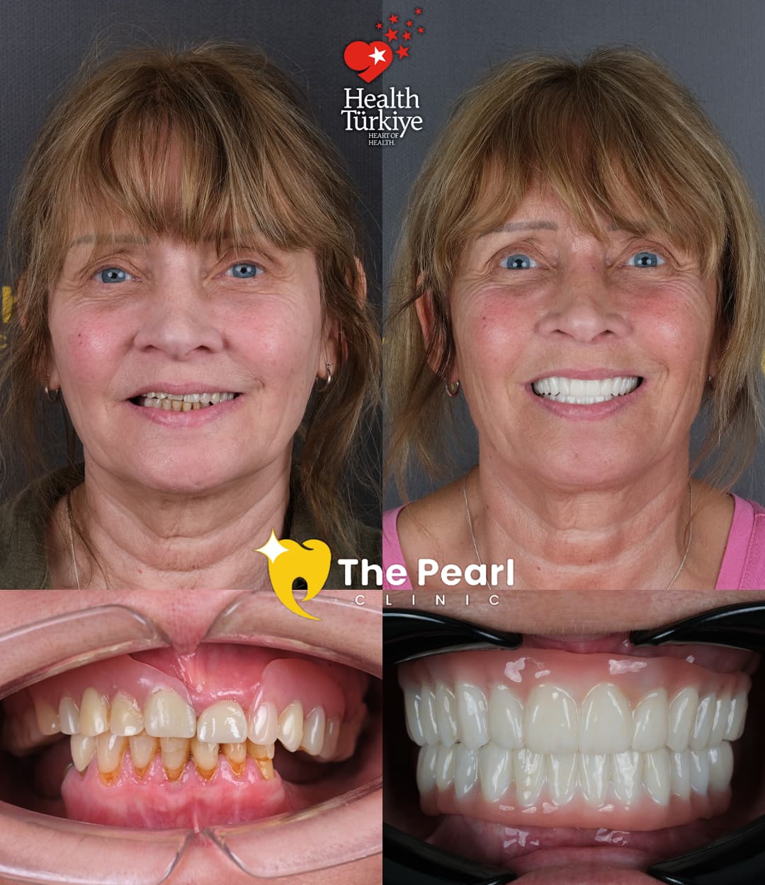 All-on-6 – 1M2 – Натуральный стиль