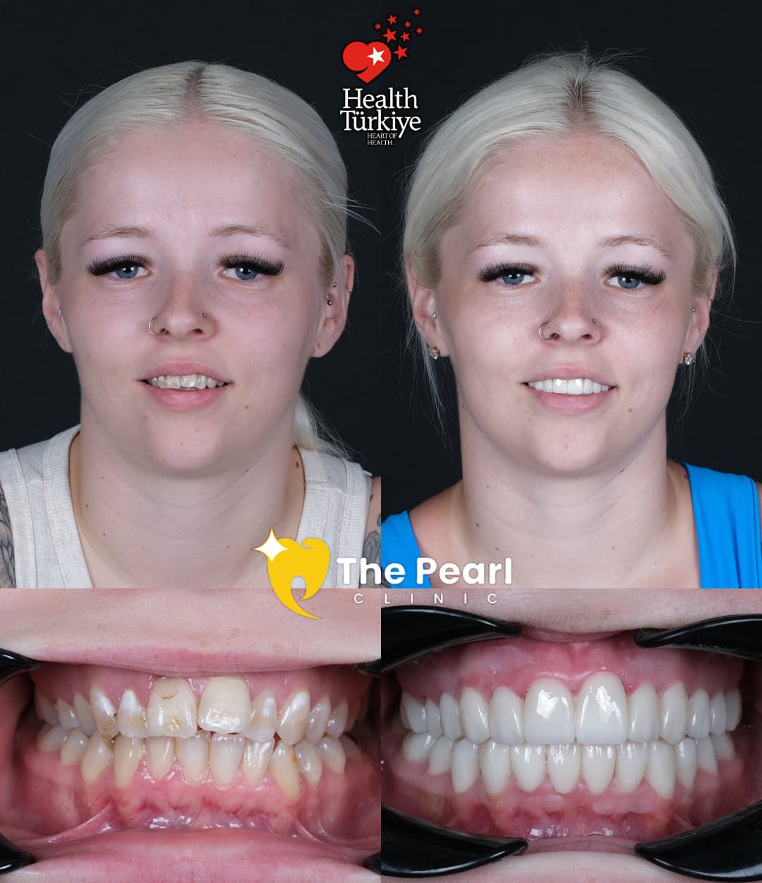 Циркониевые коронки