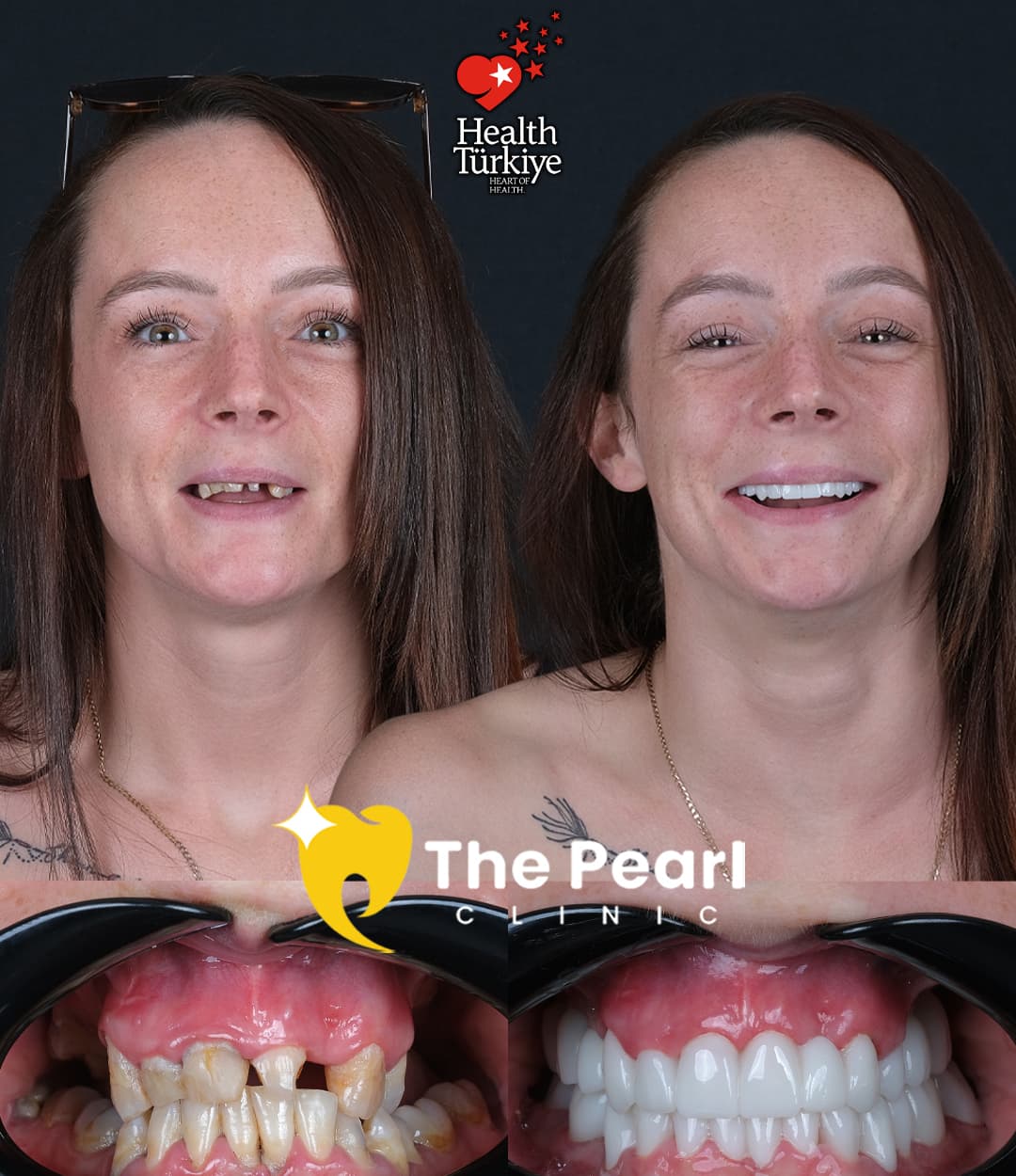 Циркониевые коронки