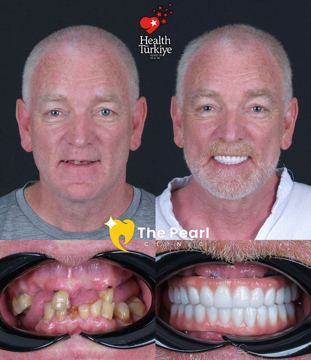 All-on-6 – BL3 - Натуральный стиль