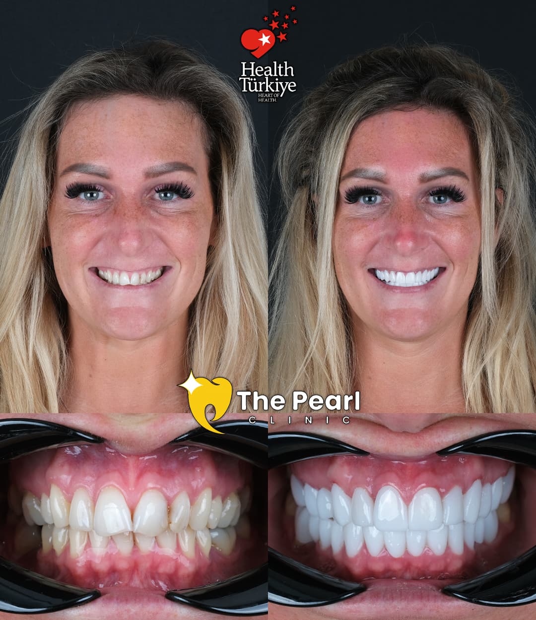 Zirconium Crowns-OM1-Natural