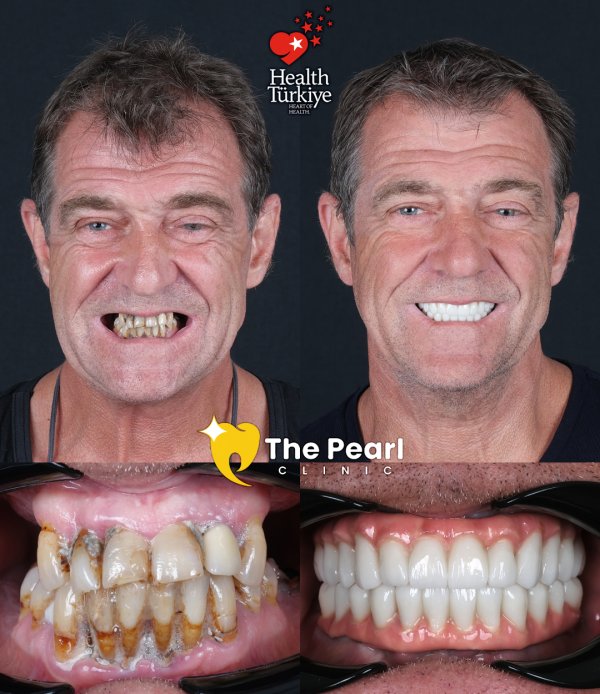 Full Zirconium Crowns – BL2