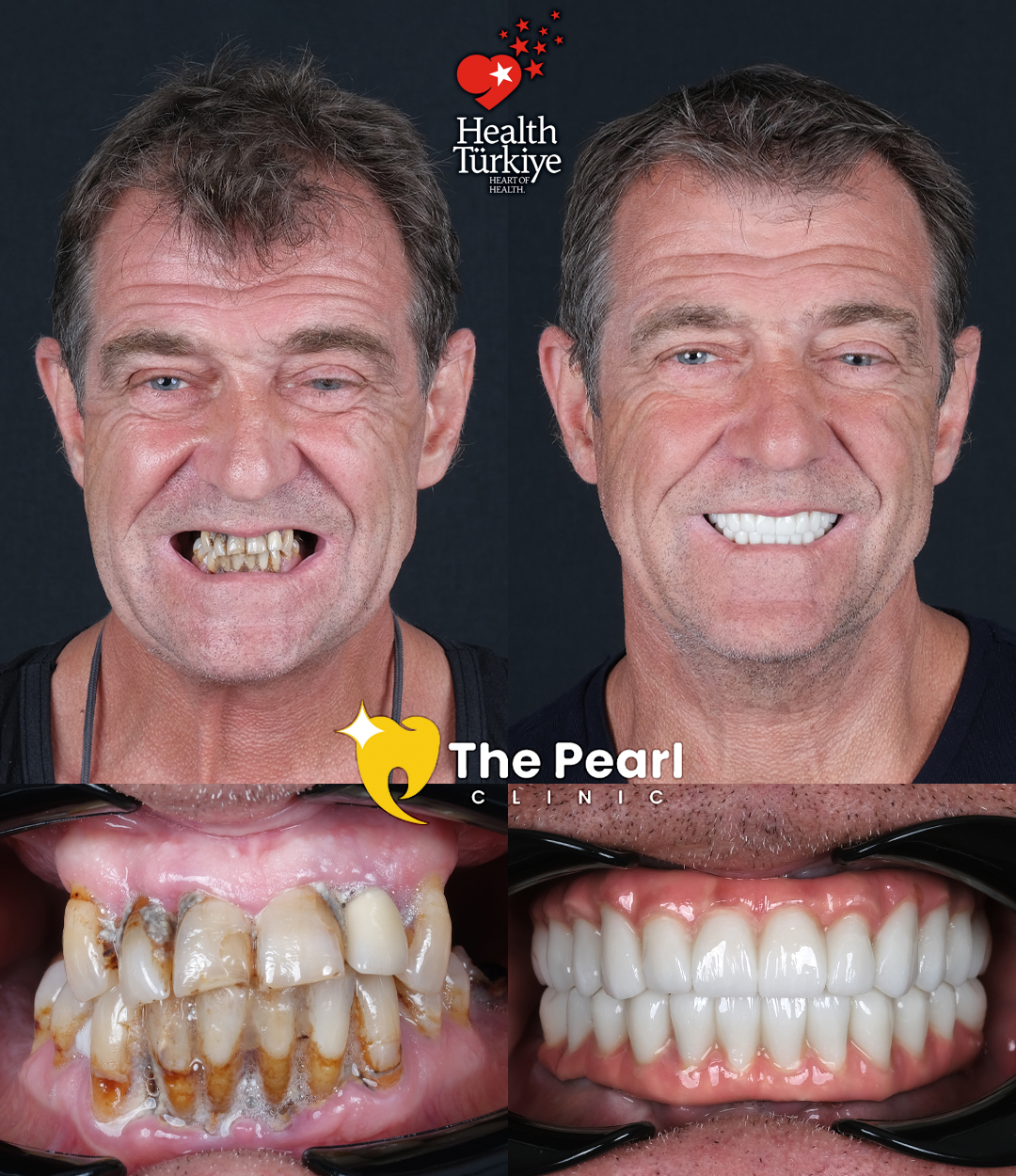 All-on-6  – 1M1 -Natural Style