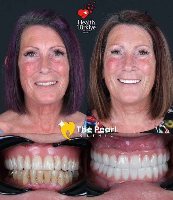 20 E-max Laminate Veneers – BL1