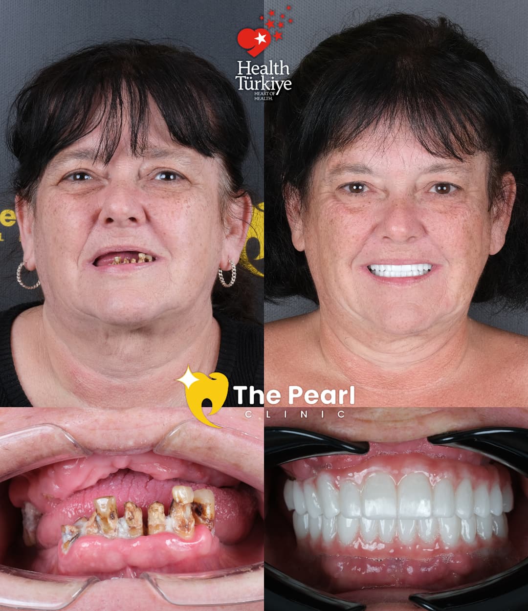 All-on-4 – BL3 – Softened Style