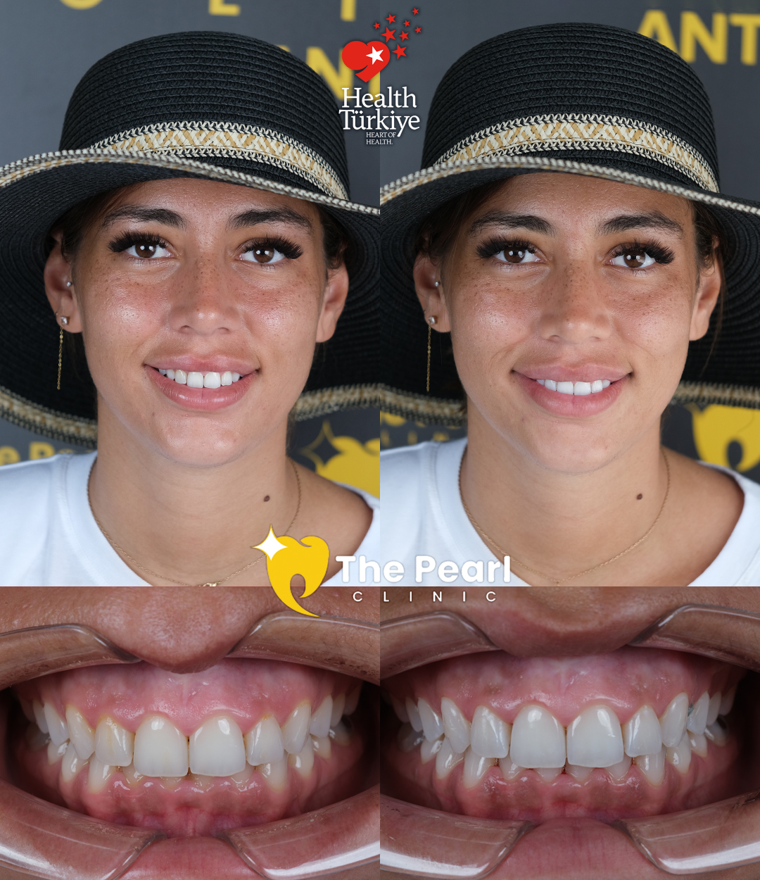 Отбеливание