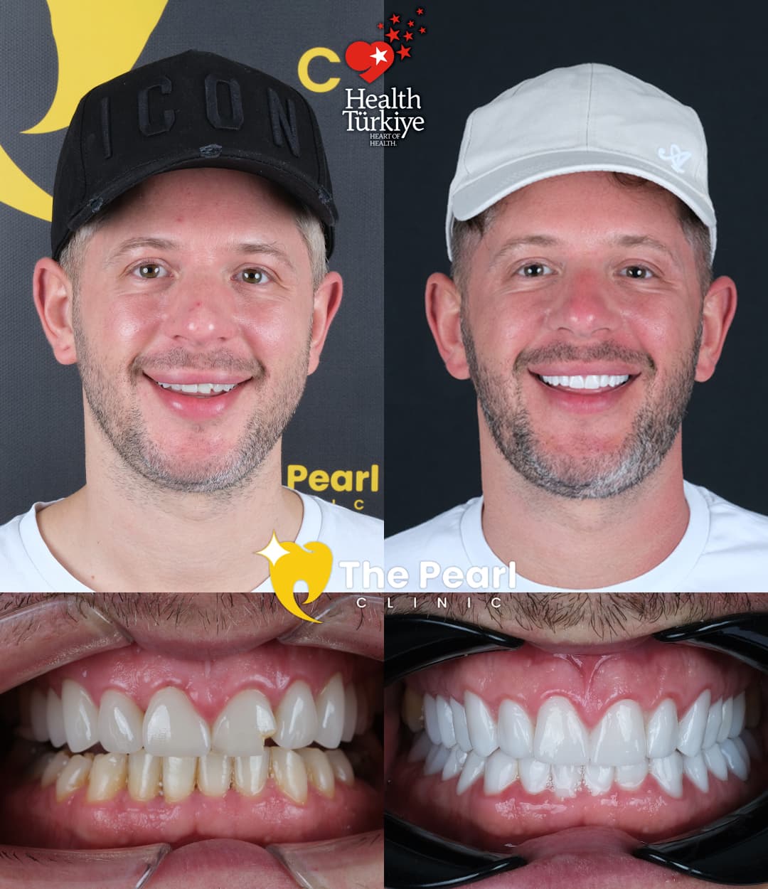 Ламинированный шпон – BL2 – Натуральный стиль