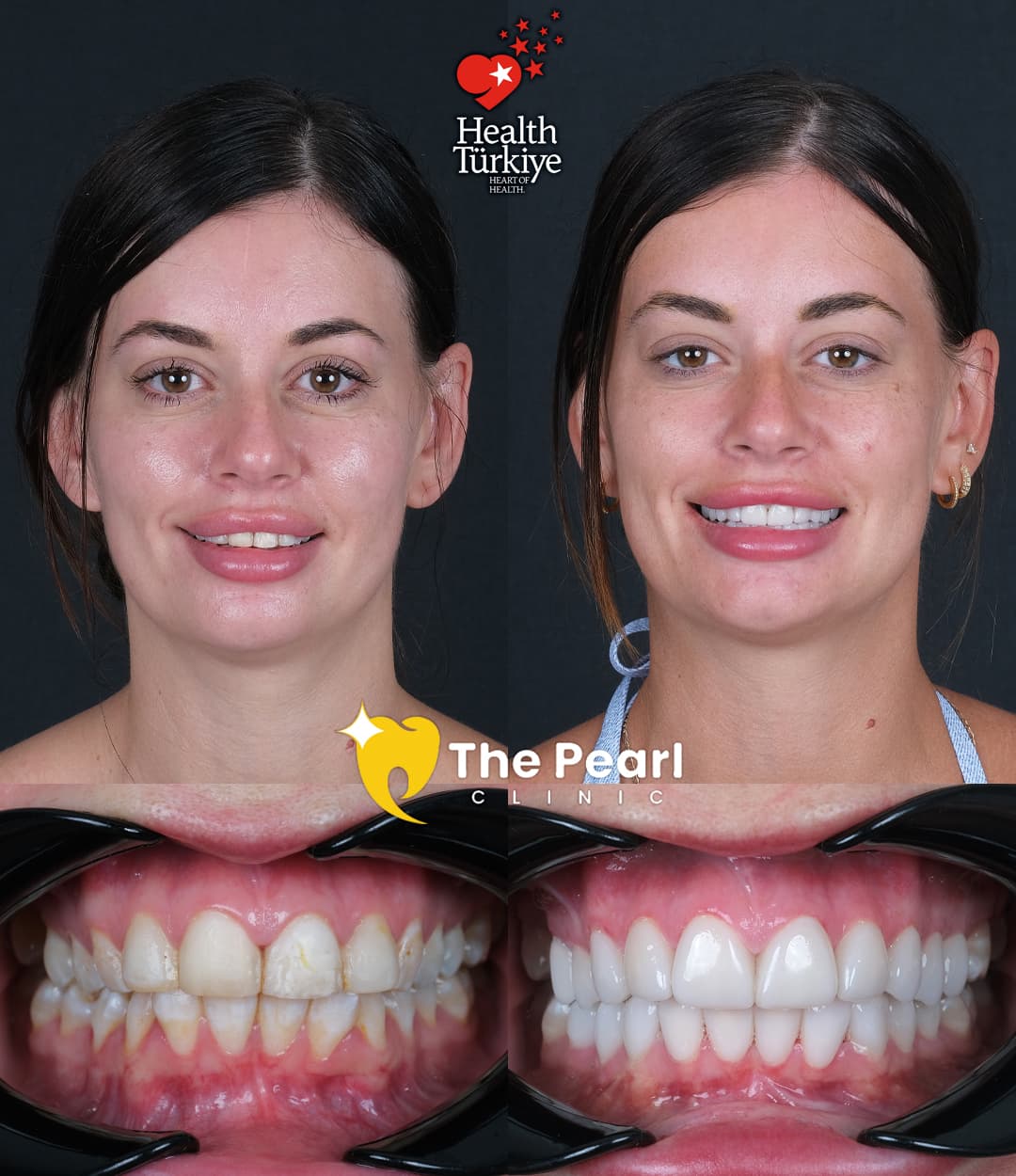 Ламинированный шпон – BL2 – Натуральный стиль