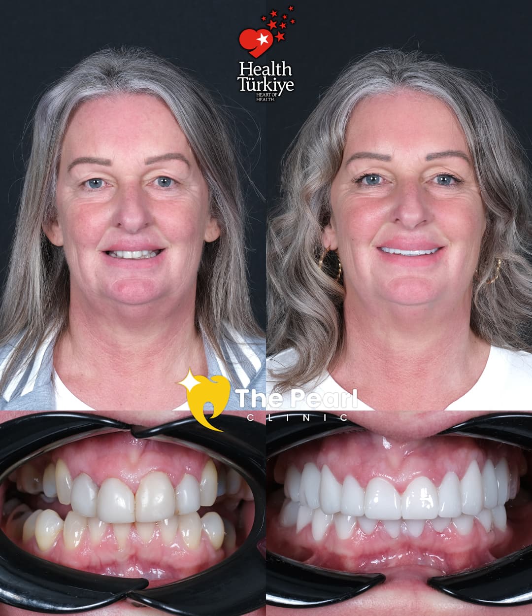 Циркониевые коронки