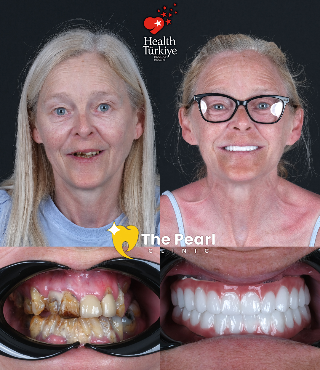 All-on-4 Full Mouth Rehabilitation