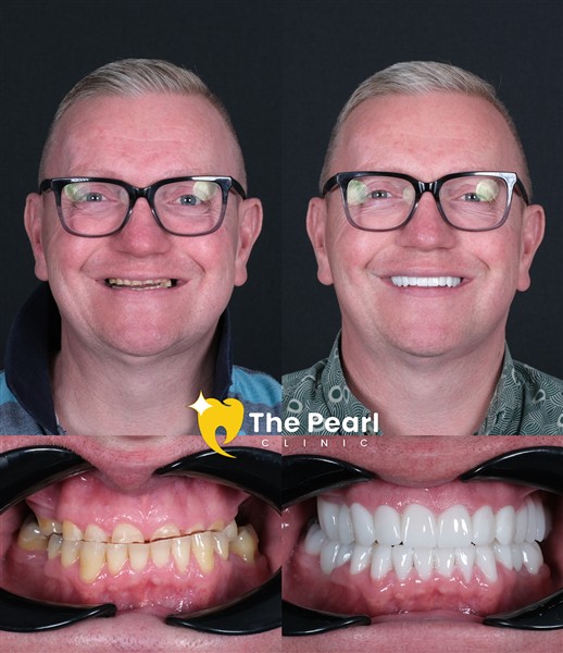 Neil Before Treatment