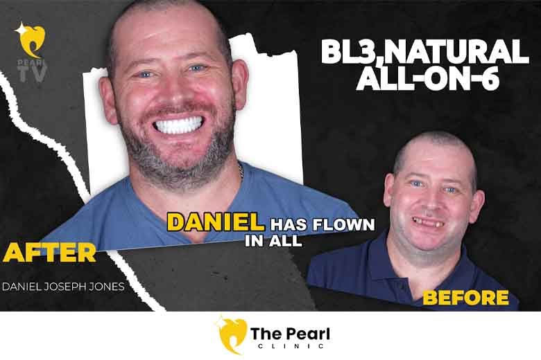 From Kent to Antalya: Daniel’s All-on-6 Dental Transformation at The Pearl Clinic