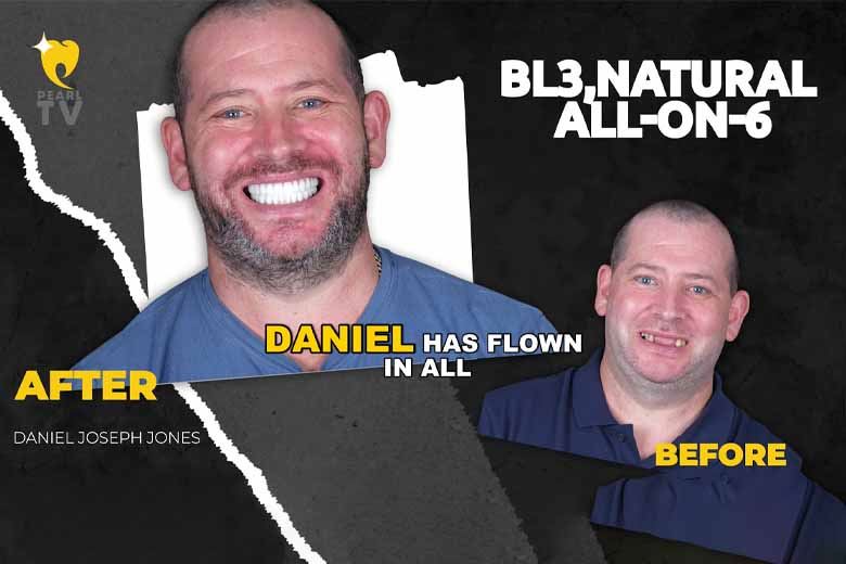From Kent to Antalya: Daniel’s All-on-6 Dental Transformation at The Pearl Clinic