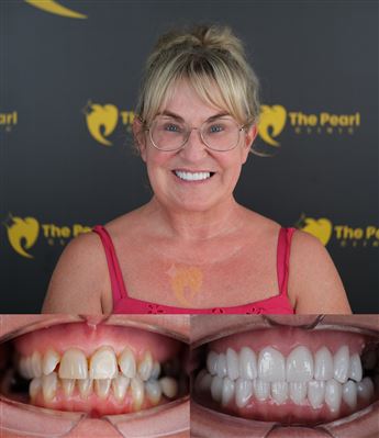 Zirconia BL2 Natural Tooth Treatment for Aesthetic Excellence